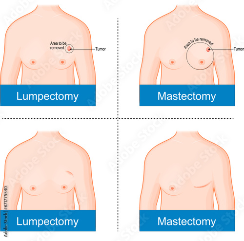Mastectomy and Lumpectomy.