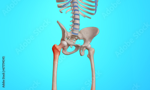 Intertrochanteric fracture on the femur head skeleton 3D medical illustration
