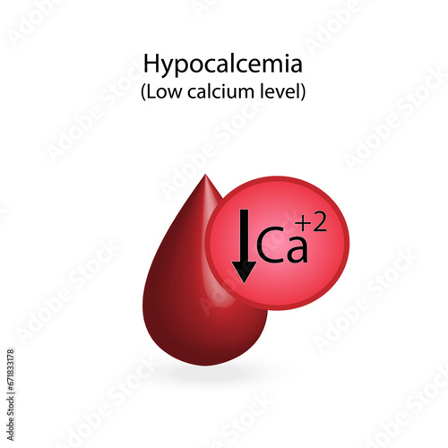 Hypocalcemia, low plasma calcium level. Calcium excess and deficit electrolyte disorders, blood droplet, Scientific design. Vector illustration.