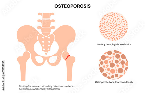 Osteoporosis medical poster