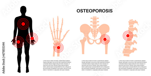 Osteoporosis medical poster