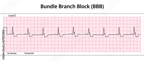 ECG Bundle Branch Block - 8 Second ECG Paper - Electrocardiogram Vector Medical Illustration