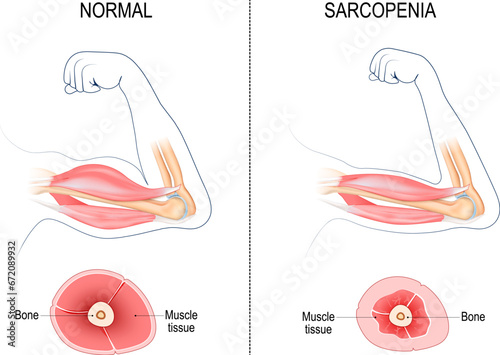 Sarcopenia.  Muscle loss. photo