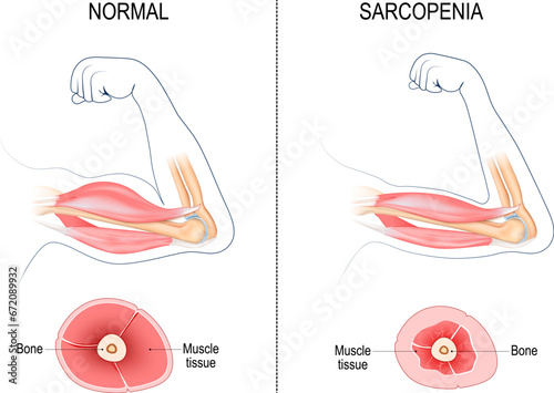Sarcopenia.  Muscle loss.