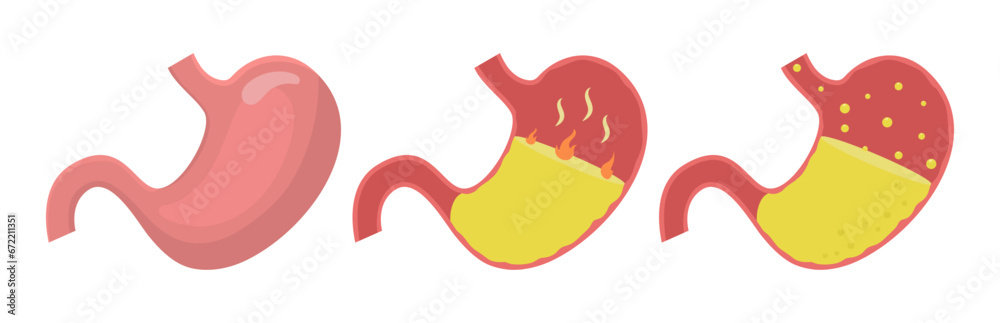 Healthy human stomach, heartburn and gastroesophageal reflux disease vector illustration Healthy human stomach, heartburn and gastroesophageal reflux disease vector illustration