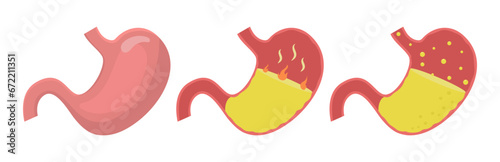Healthy human stomach, heartburn and gastroesophageal reflux disease vector illustration