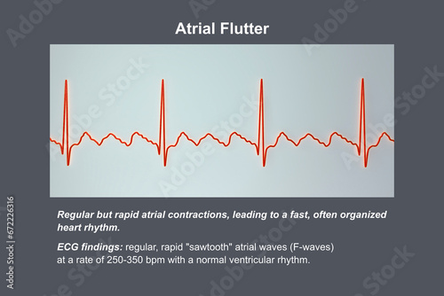 ECG in atrial flutter, an abnormal heart rhythm characterized by rapid, regular contractions of the atria, 3D illustration