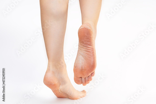 Female legs with flaky peeling heels. White background. Copy space. Skin care and pedicure