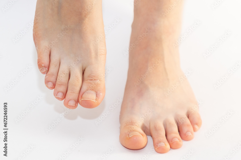 Close-up of woman's legs with flaky skin on toes. White background. Concept of pedicure and cosmetology Close-up of woman's legs with flaky skin on toes. White background. Concept of pedicure and cosmetology
