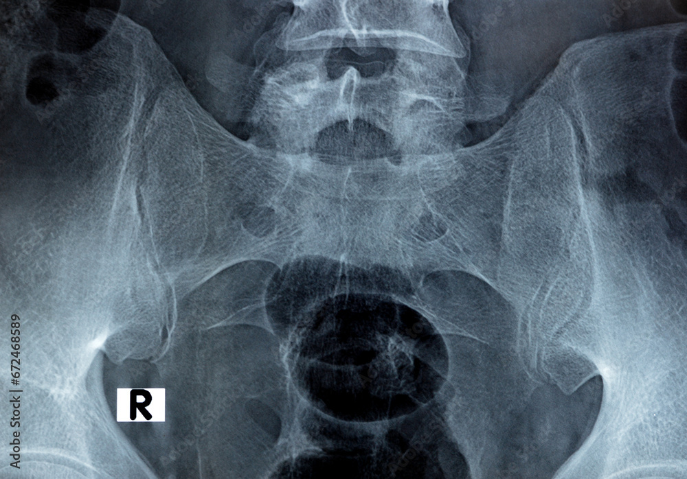 Sacroiliac joint digital radiograph examination Xray reveals preserved