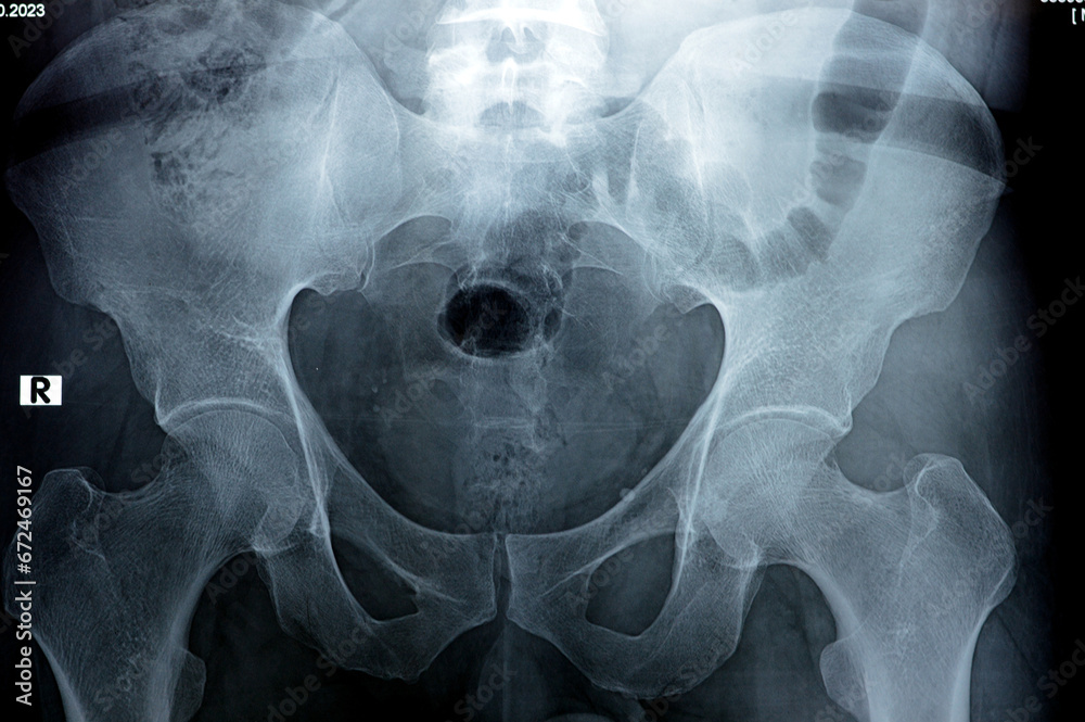 Hip Joints Digital Radiographic Examination Reveals Normal Appearance