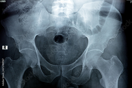 Hip joints digital radiographic examination reveals normal appearance of hip joins, multiple pelvic phleboli, bilateral coxa profunda, preserved spherical contour of femoral head, selective focus photo