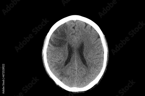 CT scan of human brain imaging on a black background. Xray showed cerebral infarction in hemiparesis patient in hospital.Doctor did medical treatment.Computer tomography scan of brain.Emergency care. photo