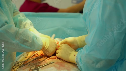 surgery on patient's open abdomen close-up, sterile medical instruments, surgeons working together. purulent peritonitis.