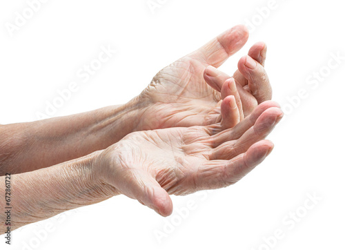 Foto Hands of an old woman with Dupuytren's contracture disease