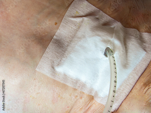 Percutaneous endoscopic gastrostomy (PEG) is an endoscopic medical procedure in which a tube (PEG tube).