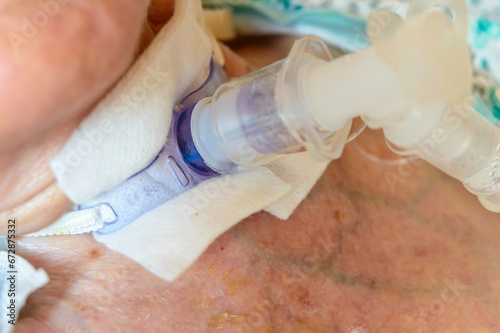 Closeup tracheal tube or tracheostomy tube.
