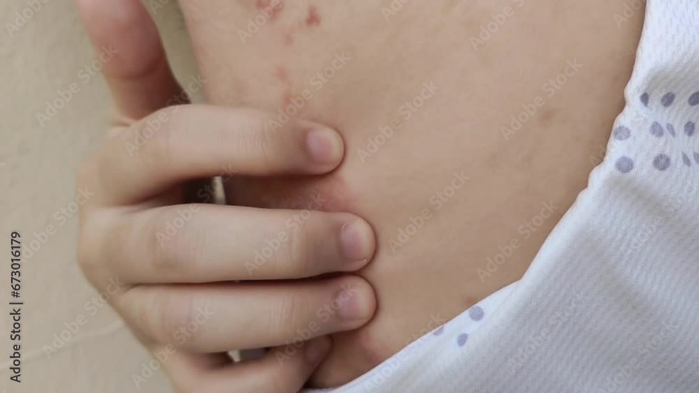 Portrait showing the fingers scratching the back, rash, hives, allergy of the woman, health care and medical concept.