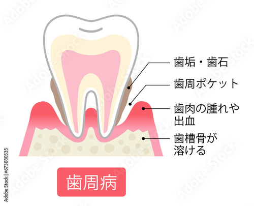 Photo 歯周病　断面図