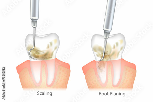 Φωτογραφία Difference of the Periodontal Scaling and Root Planing