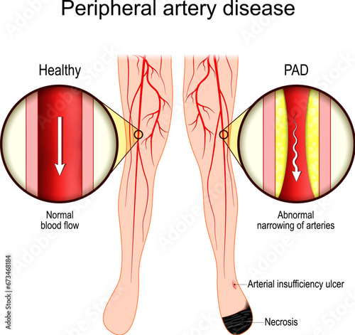 PAD. Peripheral Artery Disease. Vascular disease. photo