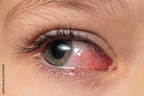 Closeup irritated infected red bloodshot eyes, conjunctivitis photo