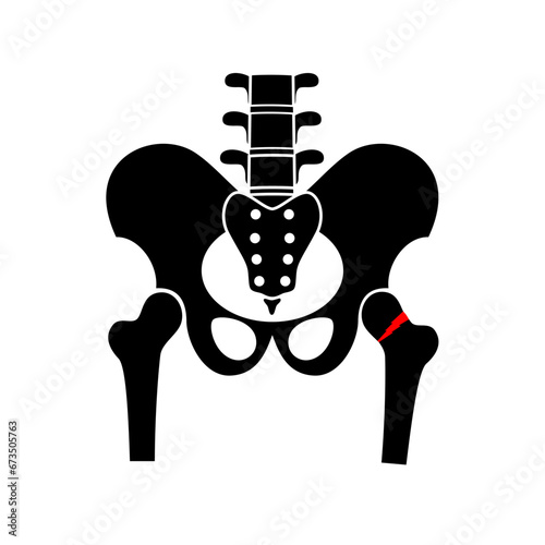 Hip bone fracture