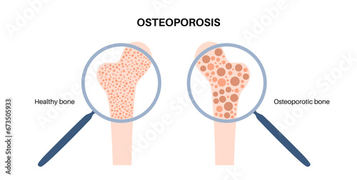 Osteoporosis medical poster
