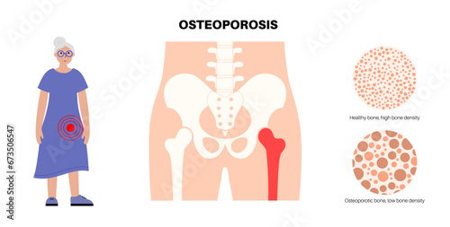 Osteoporosis medical poster