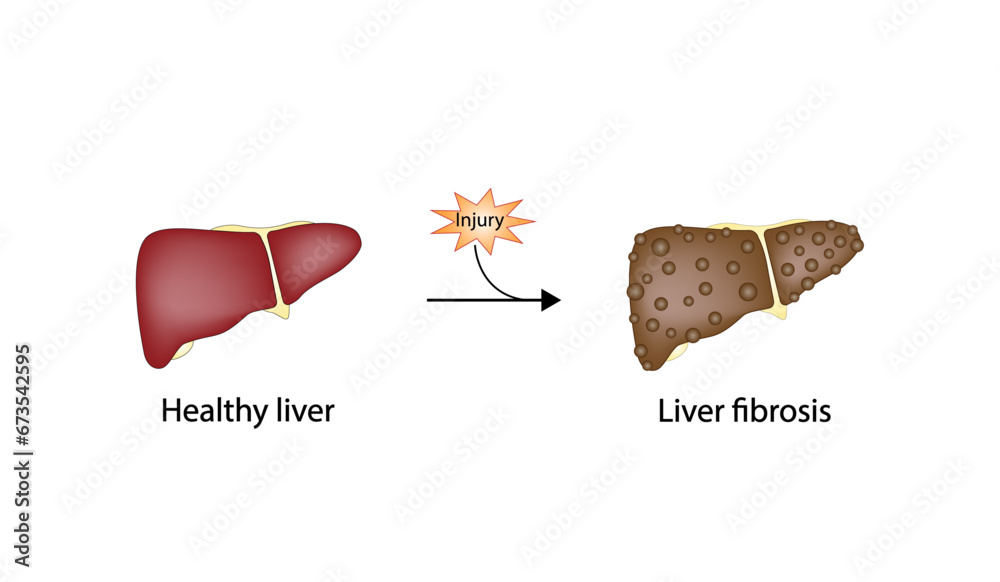 Liver fibrosis. Liver injury. Hepatic stellate cell, HSC. Vector illustration. - obrazy, fototapety, plakaty 