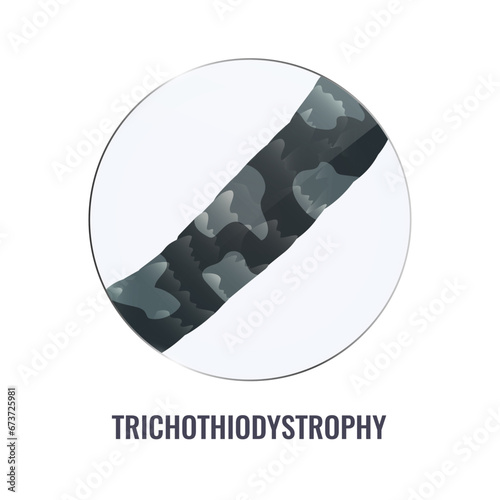 Trichothiodystrophy damaged hair surface under microscope. Hair follicle brittle condition closeup trichoscopy vector. Problem of fragility and breakage. Trichology medical concept.