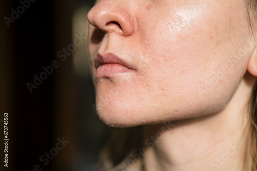The woman skin flakes off at the mouth. Dry skin. Face skin irritation after peeling, after cold windy weather. Dark background, view by profile