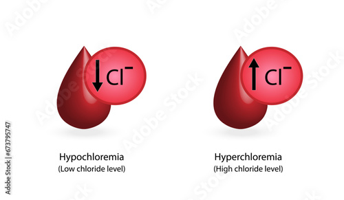 Hyperchloremia, high plasma chloride level and Hypochloremia, low plasma chloride level. Chloride excess and deficit electrolyte disorders, blood droplet, Scientific design. Vector illustration.