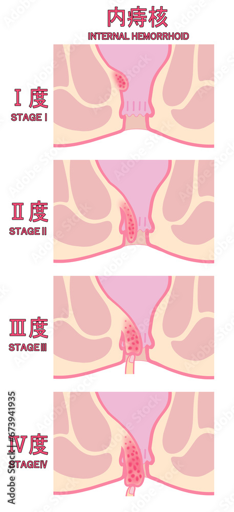 内痔核の進行度による分類のイラスト