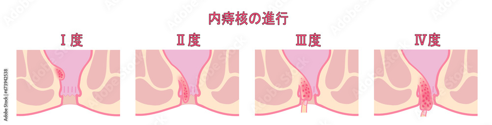 Obraz premium 内痔核の進行度による分類のイラスト