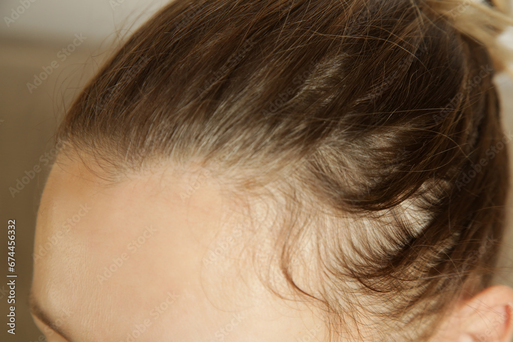 Close up of woman with serious hair loss problem and gray hair roots Close up of woman with serious hair loss problem and gray hair roots
