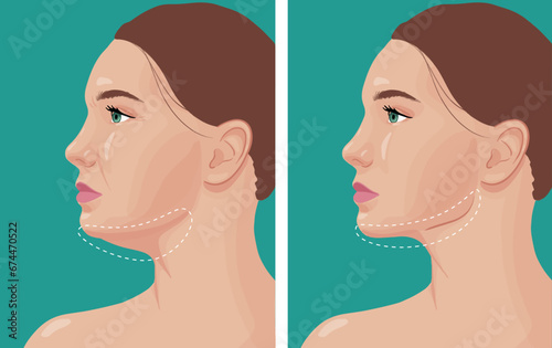 Before/After woman's chin