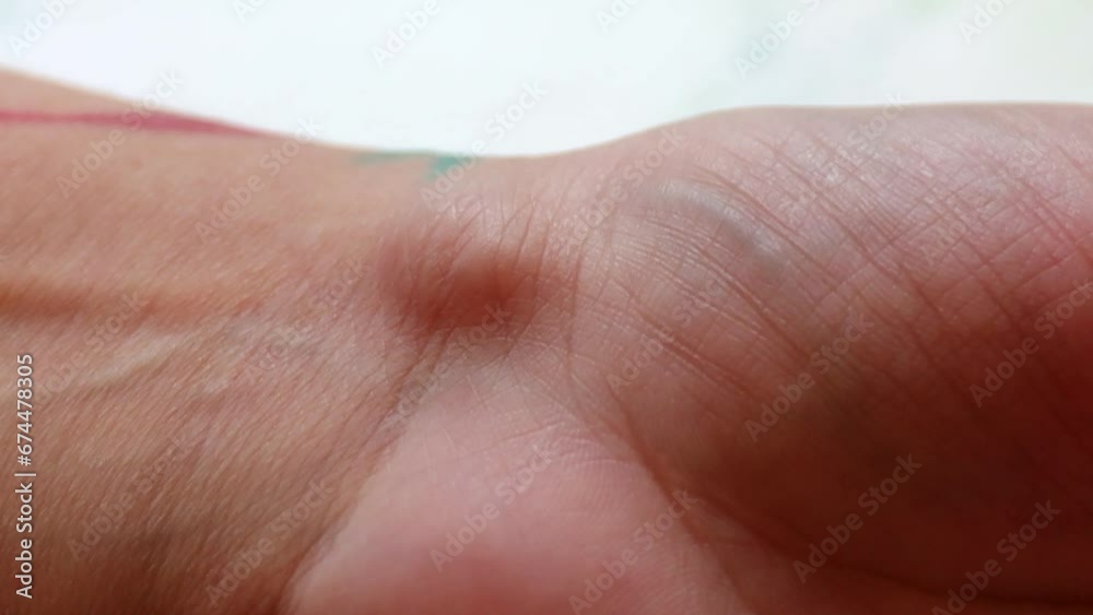 A ganglion cyst is a benign cystic tumor that forms from the superficial membranes of the joint and is a well-defined capsule. A ganglion cyst is a benign cystic tumor that forms from the superficial membranes of the joint and is a well-defined capsule.