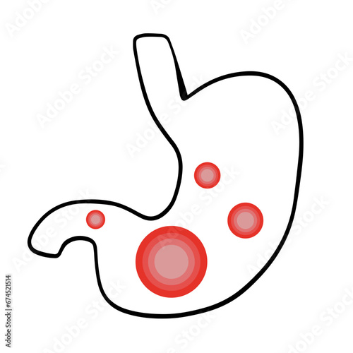 Vector isolated illustration of a stomach with colic. Localization of pain in the stomach. Gas in the stomach.