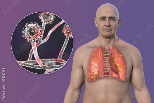 Lung histoplasmosis, a fungal infection caused by Histoplasma capsulatum, 3D illustration photo