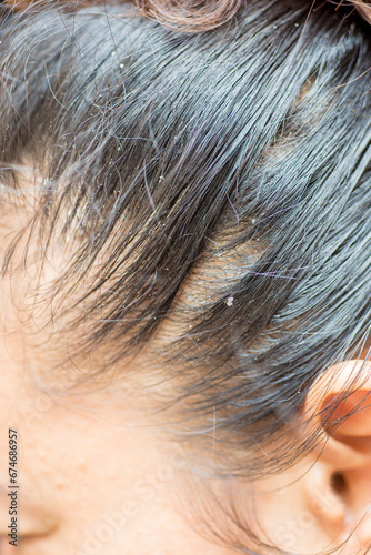 Dandruff, flaky scalp caused by dry skin. Allergy to cosmetics or has fungus photo