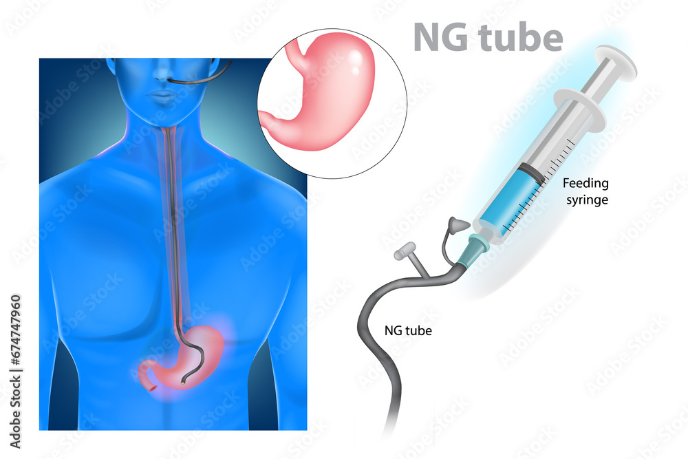 Nasogastric intubation (nasogastric tube or NG tube) Stock Illustration