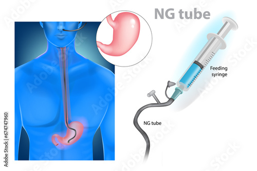 Nasogastric intubation  (nasogastric tube or NG tube)