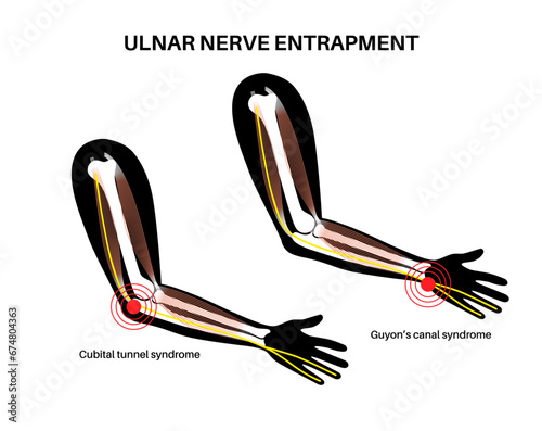 Ulnar nerve entrapment