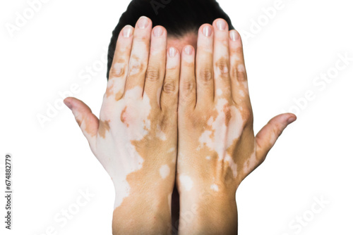 hands with vitiligo isolated
