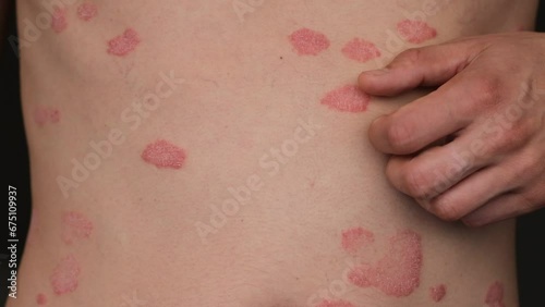 Wallpaper Mural Psoriasis Vulgaris, skin patches are typically red, itchy, and scaly. Papules of chronic psoriasis vulgaris on male hand and body. Genetic immune disease. A man scratches his stomach with his hand Torontodigital.ca