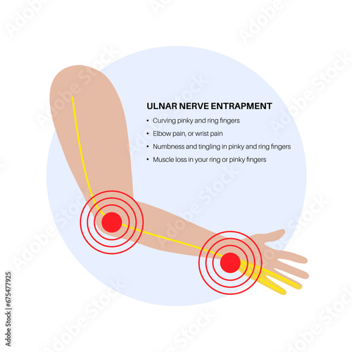 Ulnar nerve entrapment