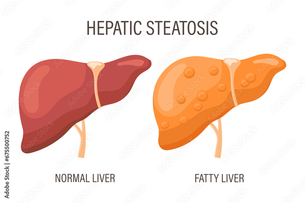 Liver steatosis, liver diseases. Healthy liver and fatty liver. Medical infographic banner. Vector - obrazy, fototapety, plakaty 
