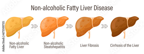 Types of fatty liver. Human liver diseases. Non-alcoholic fatty liver disease. Hepatitis, liver cirrhosis, fibrosis, steatosis. Medical infographic banner. Vector photo