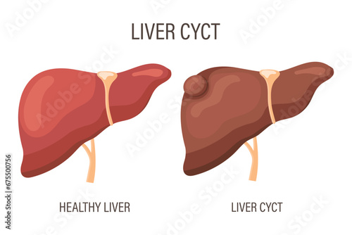 Liver cyst, liver disease. Healthy liver and liver cyst. Medical infographic banner. Vector